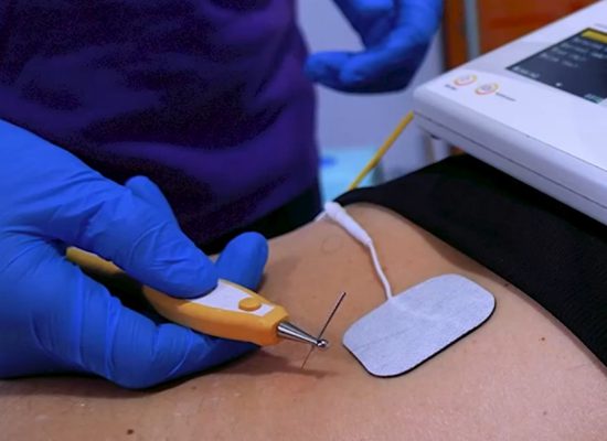 Electrólisis percutánea
