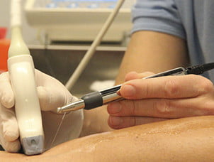 Neuromodulación percutánea